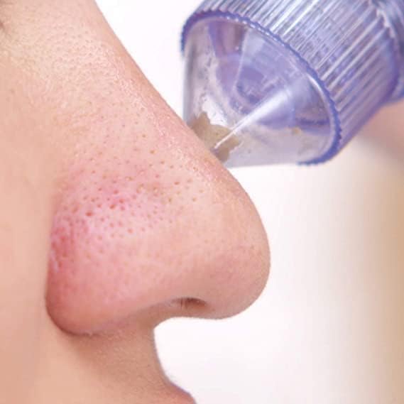 4-in-1 Blackhead Remover Vacuum – Electric Pore Cleaner with Adjustable Suction & Interchangeable Heads - Facial Device for Men & Women (Blue) (POWER CELL (AA) BATTERY INCLUDED) - Image 3